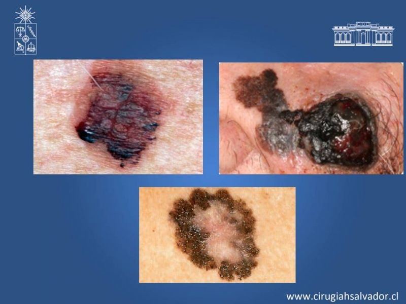 Diapositiva 12 de Manejo Quirúrgico del Melanoma 
