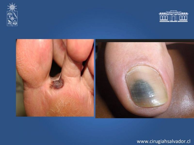 Diapositiva 13 de Manejo Quirúrgico del Melanoma 