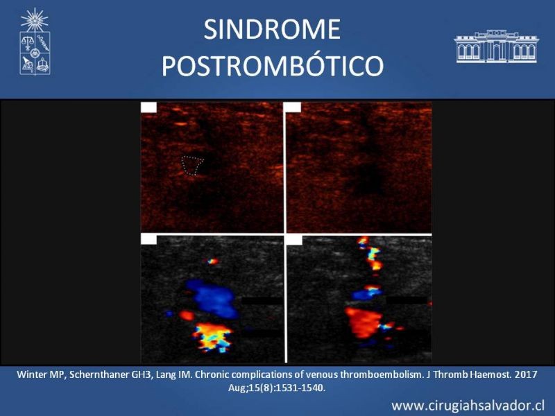 Diapositiva 11 de Indicación quirúrgica de la trombosis venosa profunda