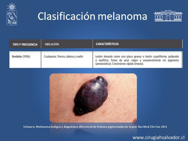 Diapositiva 9 de Manejo Quirúrgico del Melanoma 