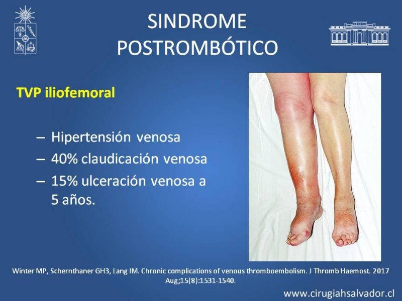 Diapositiva 15 de Indicación quirúrgica de la trombosis venosa profunda