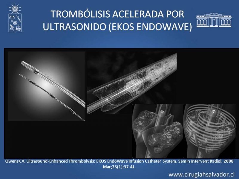 Diapositiva 27 de Indicación quirúrgica de la trombosis venosa profunda