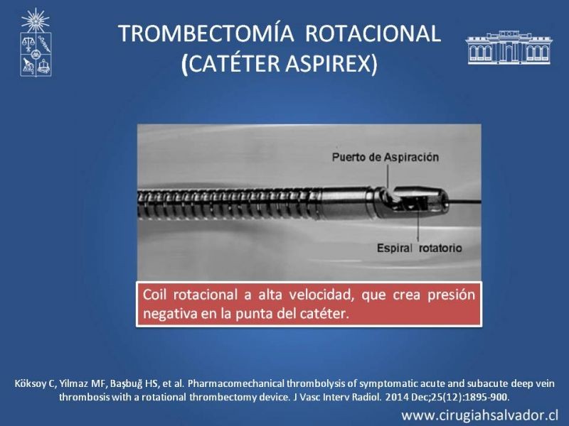 Diapositiva 28 de Indicación quirúrgica de la trombosis venosa profunda