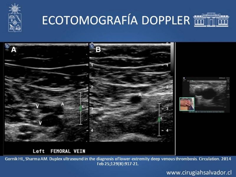 Diapositiva 2 de Indicación quirúrgica de la trombosis venosa profunda