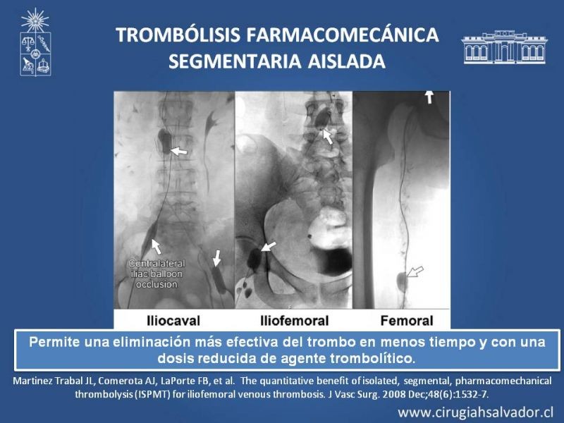 Diapositiva 30 de Indicación quirúrgica de la trombosis venosa profunda
