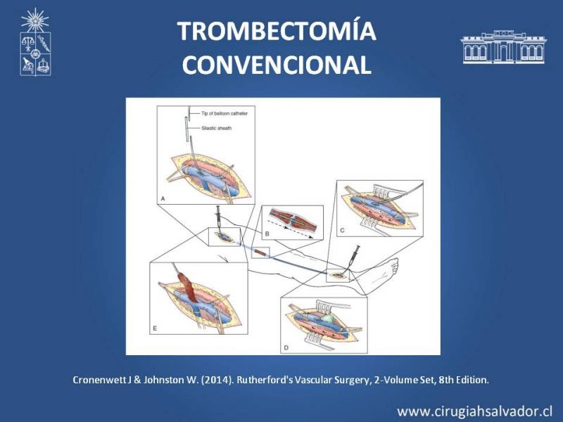 Diapositiva 44 de Indicación quirúrgica de la trombosis venosa profunda