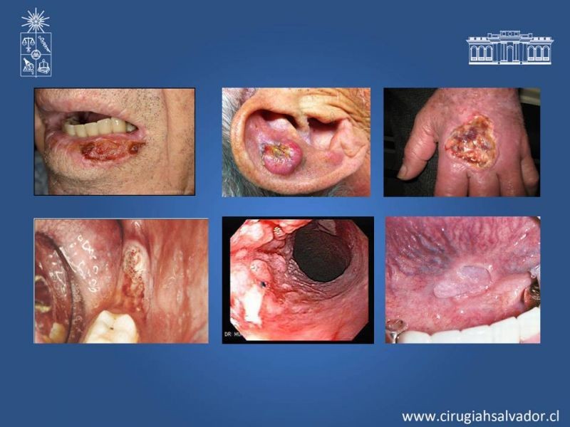 Diapositiva 4 de Ganglio centinela en Cáncer Espinocelular