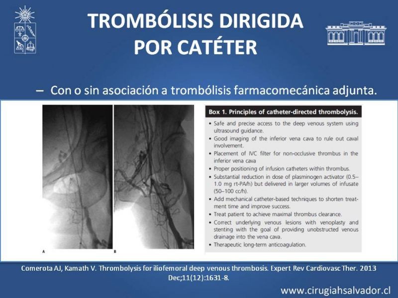 Diapositiva 19 de Indicación quirúrgica de la trombosis venosa profunda
