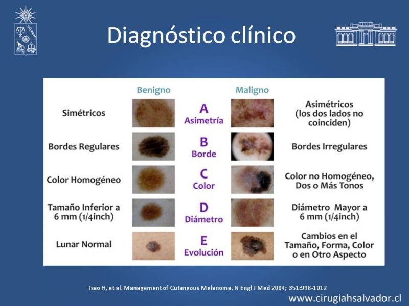 Diapositiva 7 de Manejo Quirúrgico del Melanoma 
