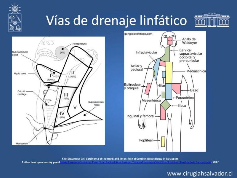 Diapositiva 16 de Ganglio centinela en Cáncer Espinocelular