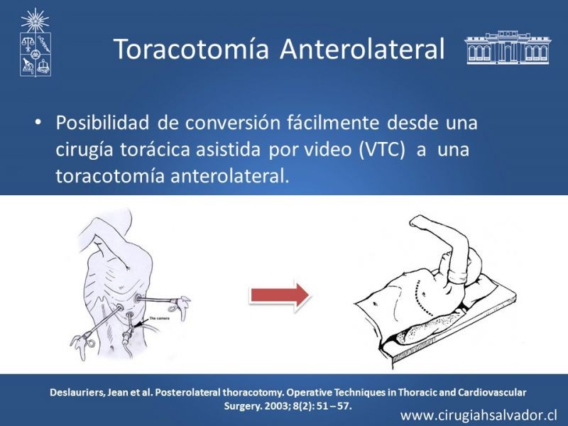 Diapositiva 23 de Accesos quirúrgicos torácicos