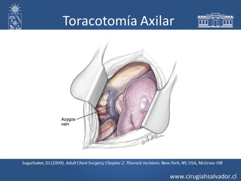 Diapositiva 49 de Accesos quirúrgicos torácicos