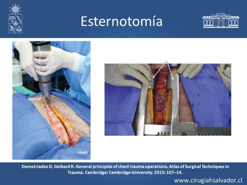 Diapositiva 54 de Accesos quirúrgicos torácicos