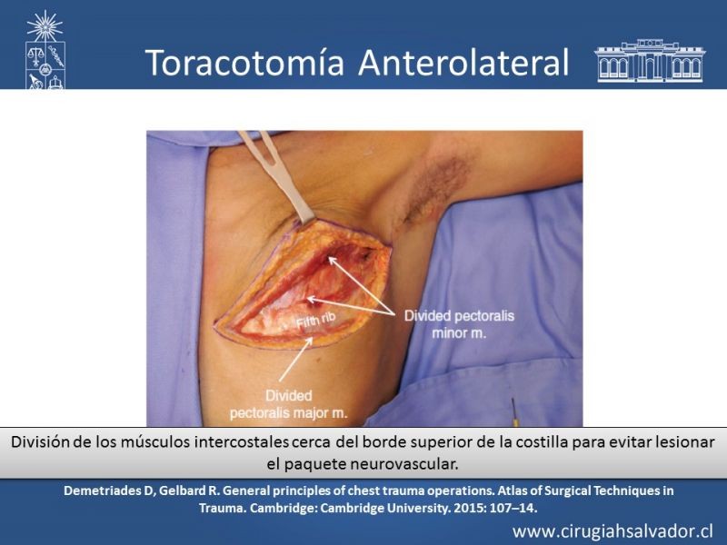 Diapositiva 28 de Accesos quirúrgicos torácicos