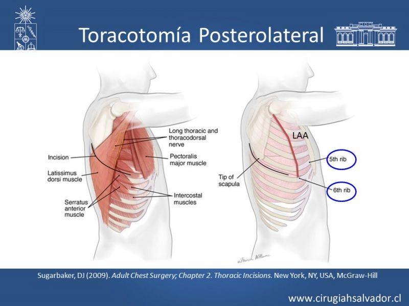 Diapositiva 9 de Accesos quirúrgicos torácicos