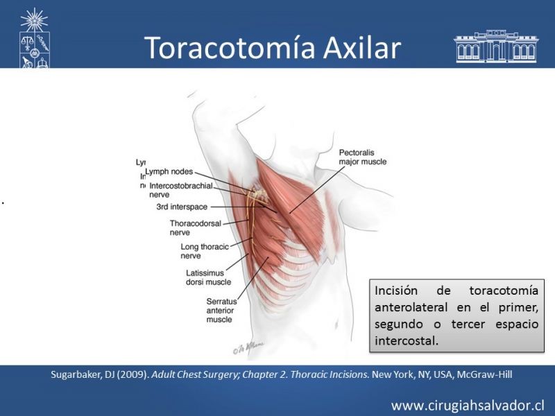 Diapositiva 39 de Accesos quirúrgicos torácicos