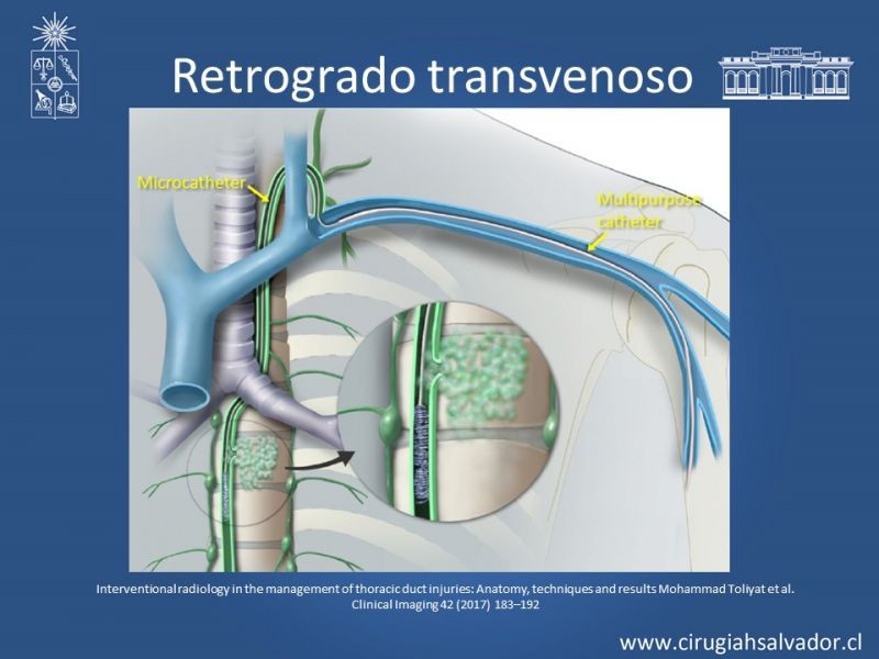 Diapositiva 26 de Ascitis quilosa secundaria a cirugía mayor abdominal