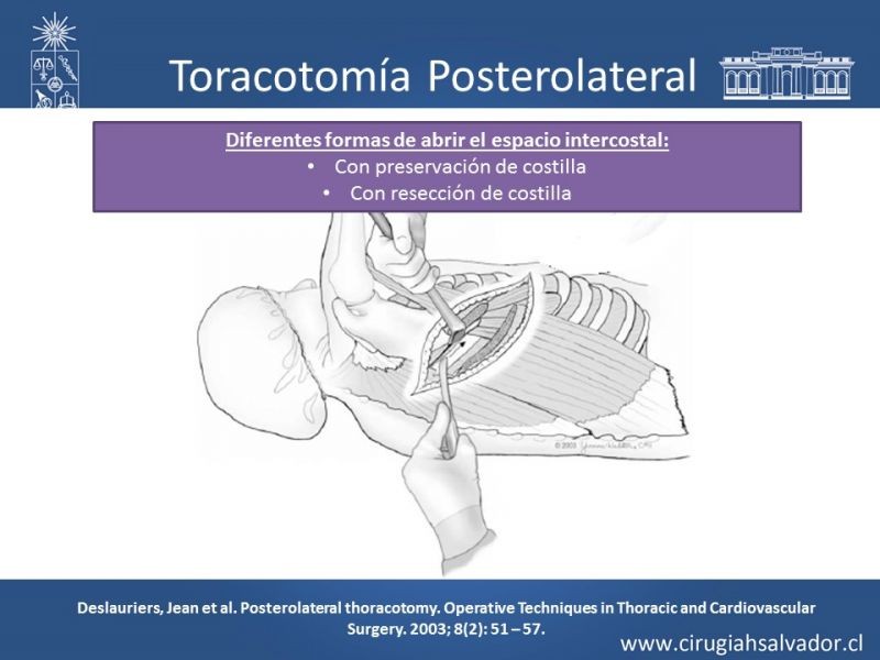 Diapositiva 12 de Accesos quirúrgicos torácicos