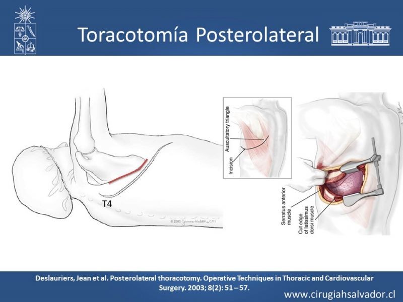 Diapositiva 10 de Accesos quirúrgicos torácicos