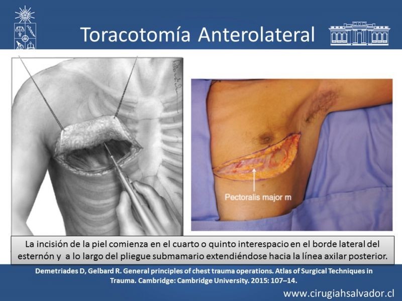 Diapositiva 26 de Accesos quirúrgicos torácicos