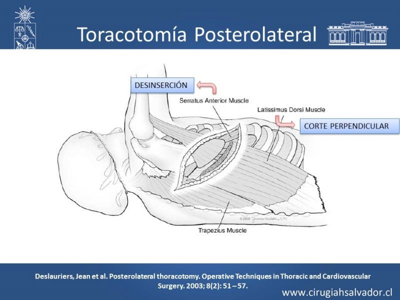Diapositiva 11 de Accesos quirúrgicos torácicos