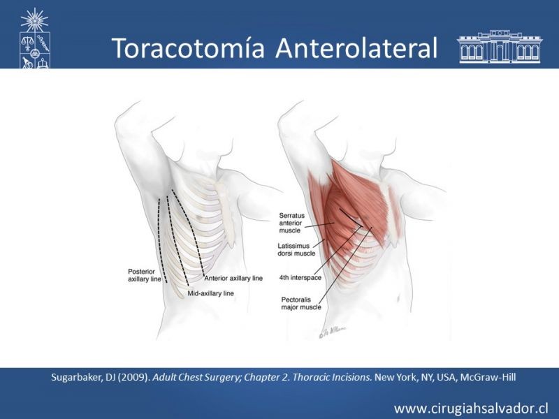 Diapositiva 25 de Accesos quirúrgicos torácicos