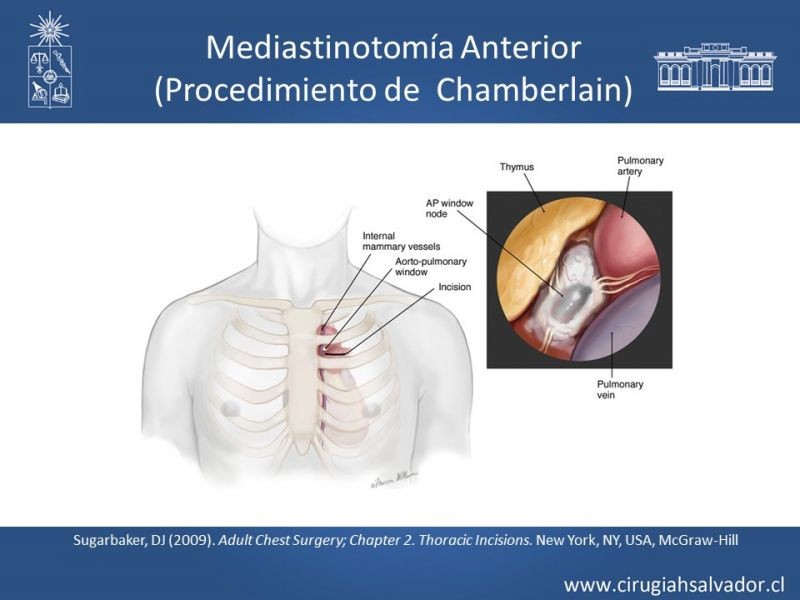 Diapositiva 42 de Accesos quirúrgicos torácicos