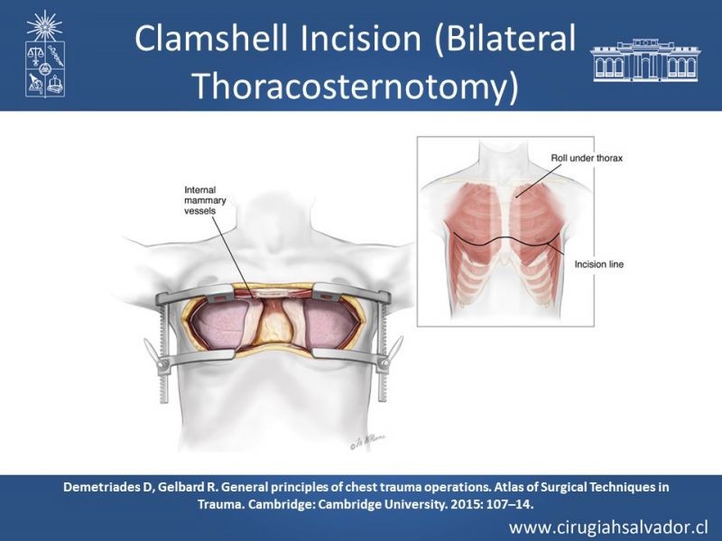 Diapositiva 35 de Accesos quirúrgicos torácicos