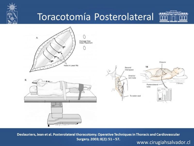 Diapositiva 19 de Accesos quirúrgicos torácicos
