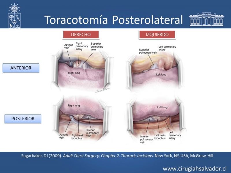 Diapositiva 14 de Accesos quirúrgicos torácicos