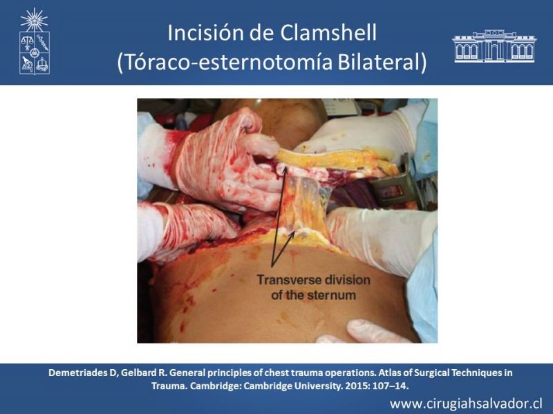 Diapositiva 36 de Accesos quirúrgicos torácicos