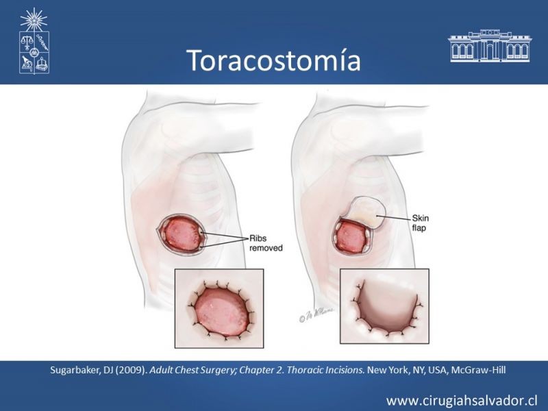 Diapositiva 45 de Accesos quirúrgicos torácicos