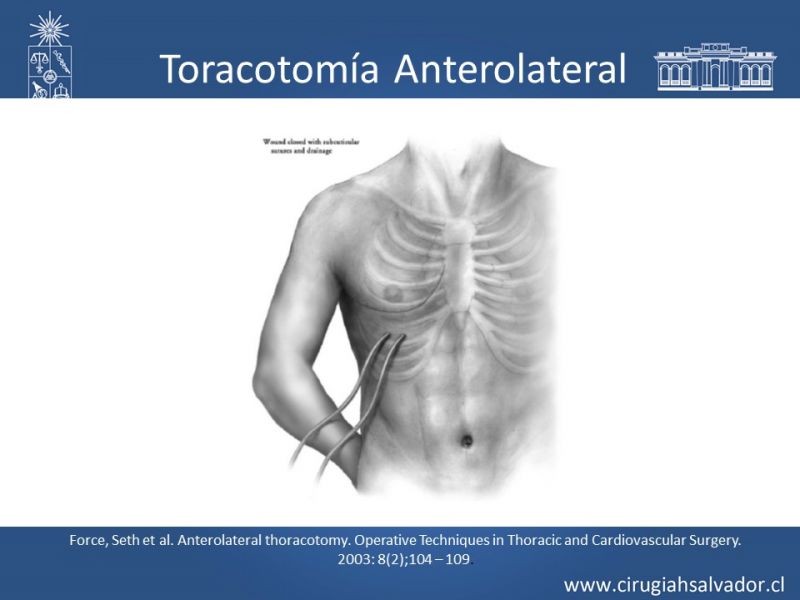 Diapositiva 30 de Accesos quirúrgicos torácicos