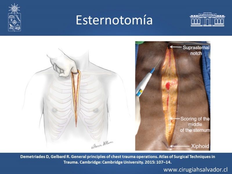 Diapositiva 53 de Accesos quirúrgicos torácicos