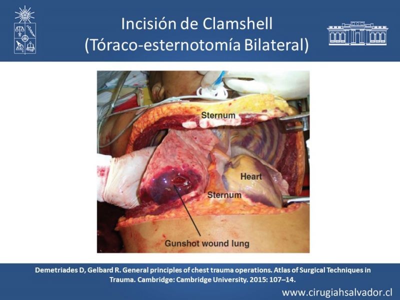 Diapositiva 37 de Accesos quirúrgicos torácicos