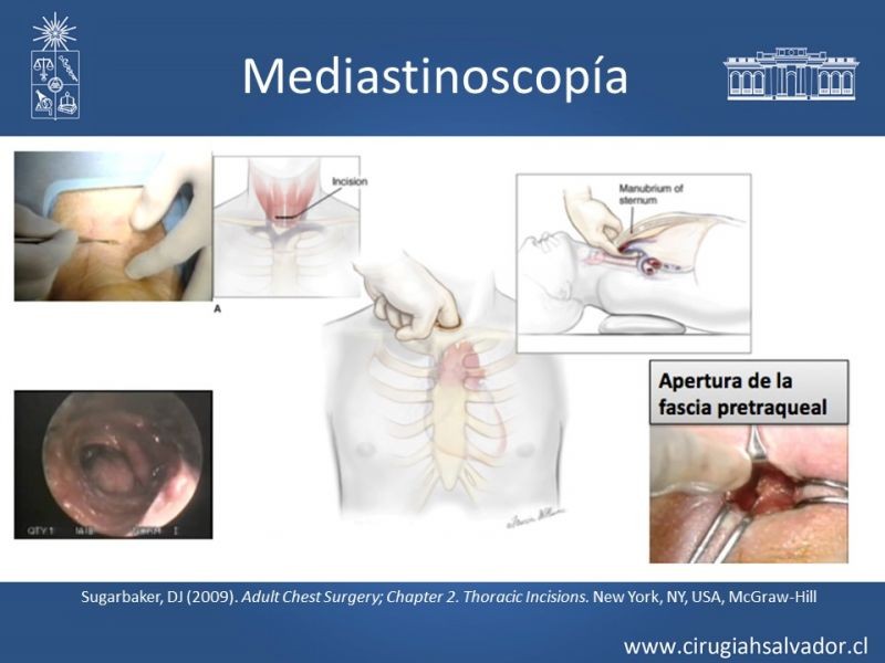 Diapositiva 59 de Accesos quirúrgicos torácicos