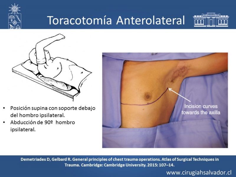 Diapositiva 24 de Accesos quirúrgicos torácicos