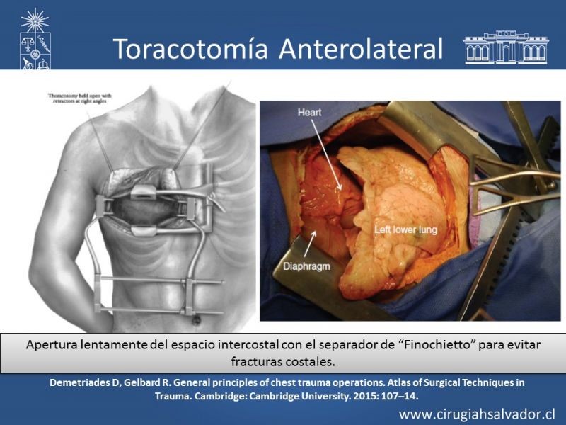 Diapositiva 29 de Accesos quirúrgicos torácicos