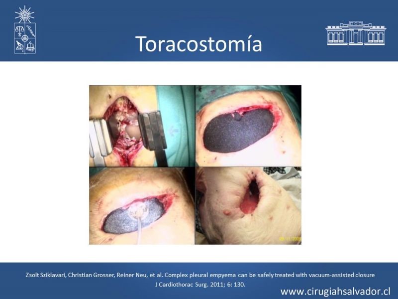 Diapositiva 46 de Accesos quirúrgicos torácicos