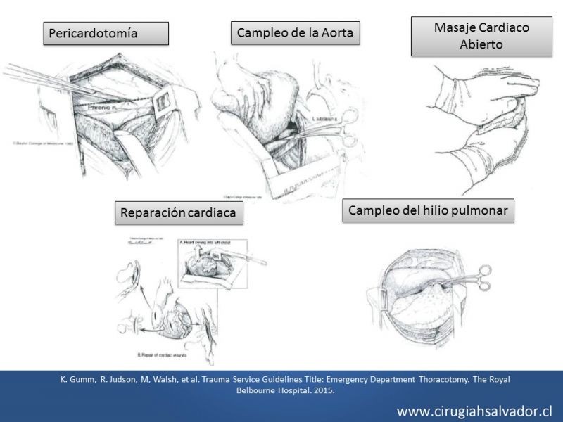 Diapositiva 32 de Accesos quirúrgicos torácicos