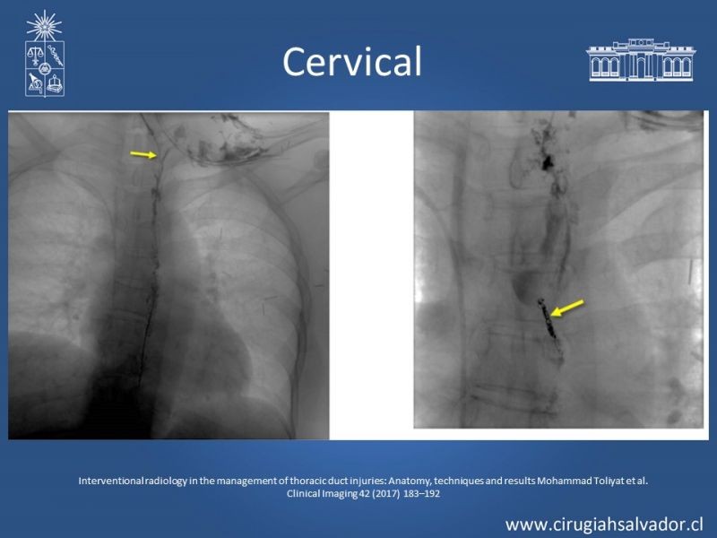 Diapositiva 25 de Ascitis quilosa secundaria a cirugía mayor abdominal
