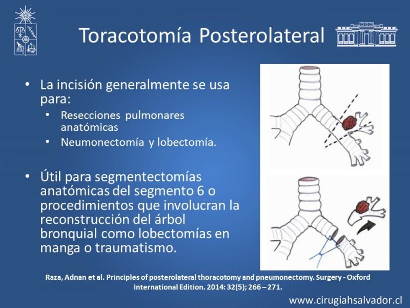 Diapositiva 17 de Accesos quirúrgicos torácicos