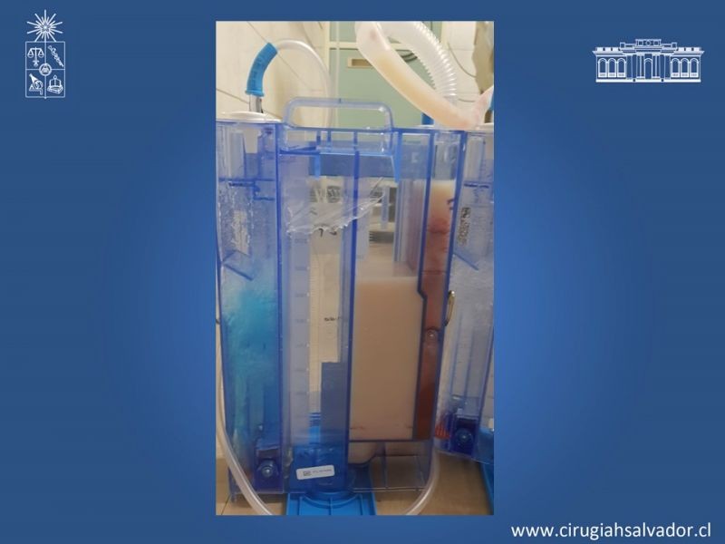 Diapositiva 3 de Ascitis quilosa secundaria a cirugía mayor abdominal