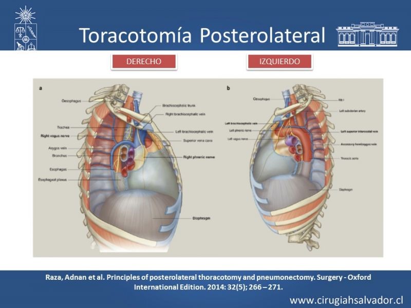Diapositiva 15 de Accesos quirúrgicos torácicos