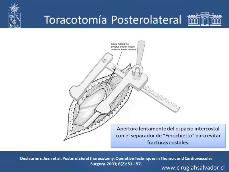 Diapositiva 13 de Accesos quirúrgicos torácicos
