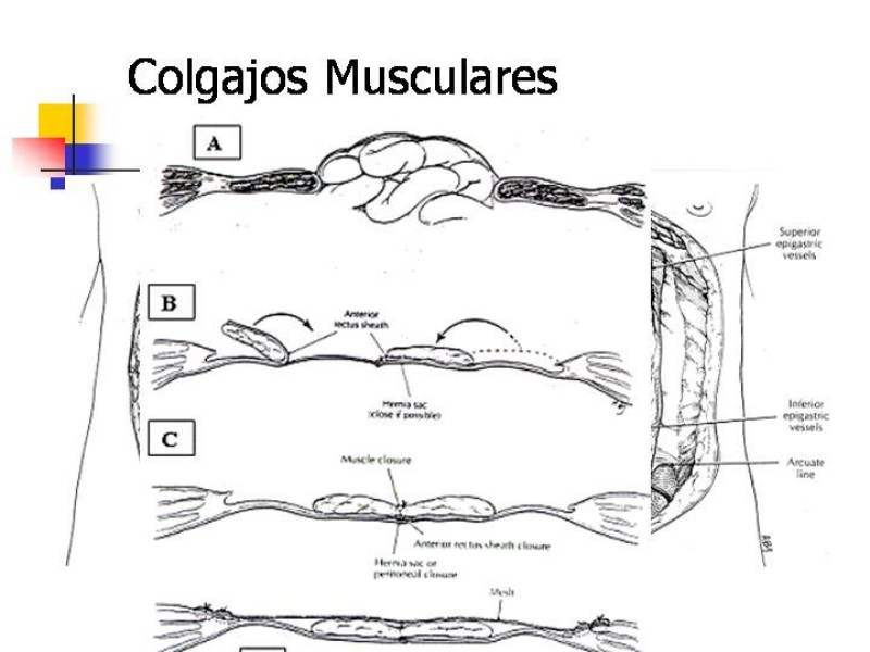 Diapositiva 10 de Hernia Incisional