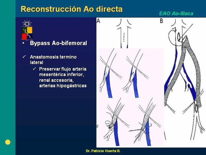 Diapositiva 10 de Tratamiento Quirúrgico de la EAO Aorto- Iliaca