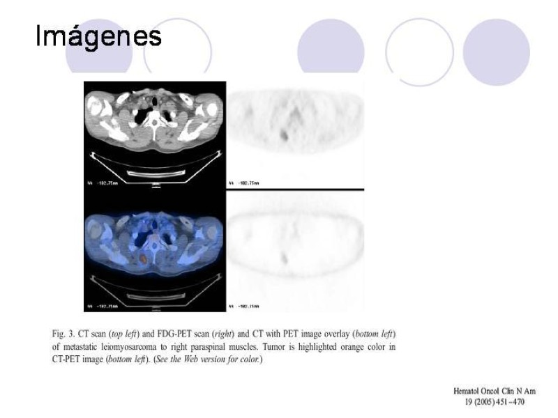 Diapositiva 20 de Sarcomas