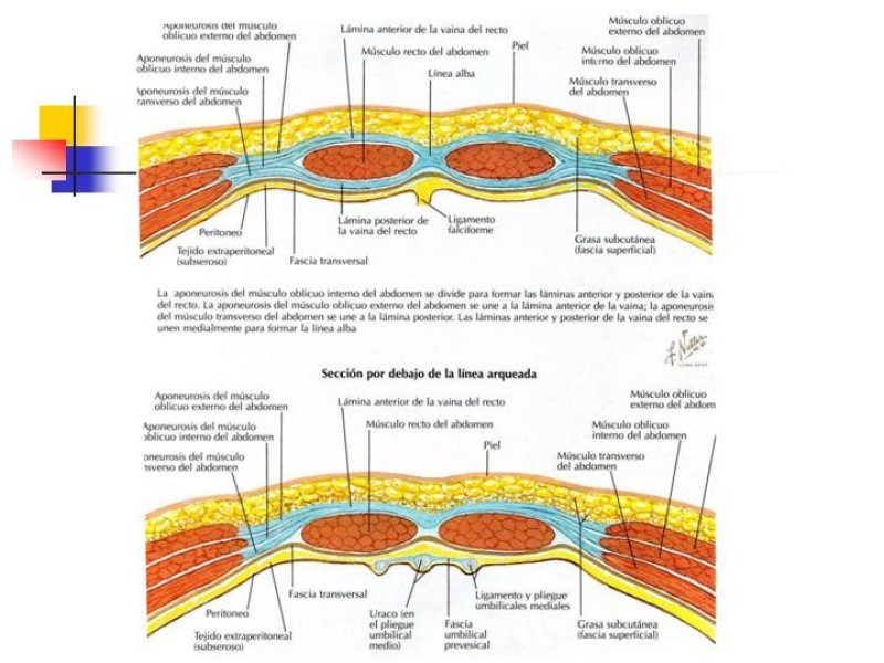 Diapositiva 5 de Hernia Incisional