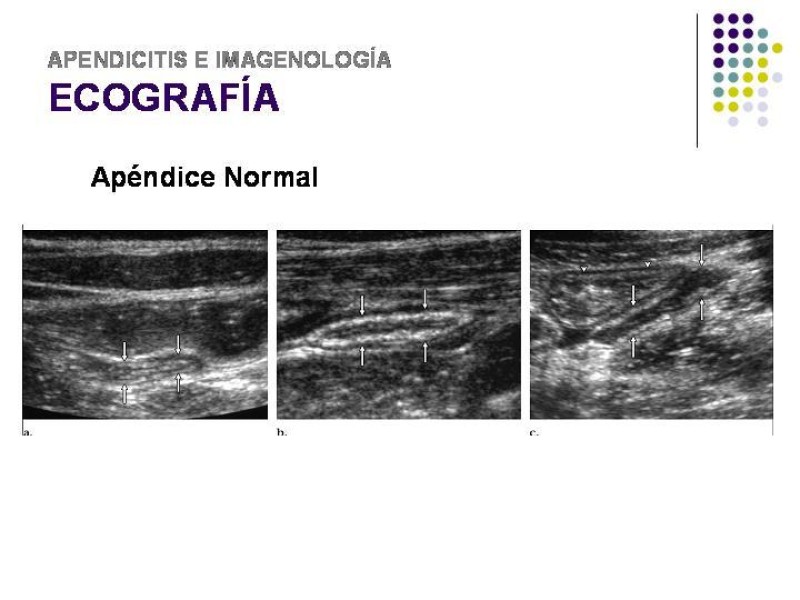 Diapositiva 21 de Imagenología y Apendicitis
